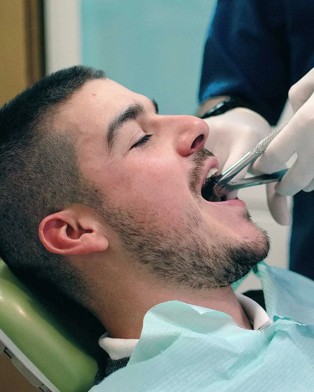 Wisdom Tooth Extraction